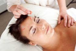 Acupuncture Acupuncture